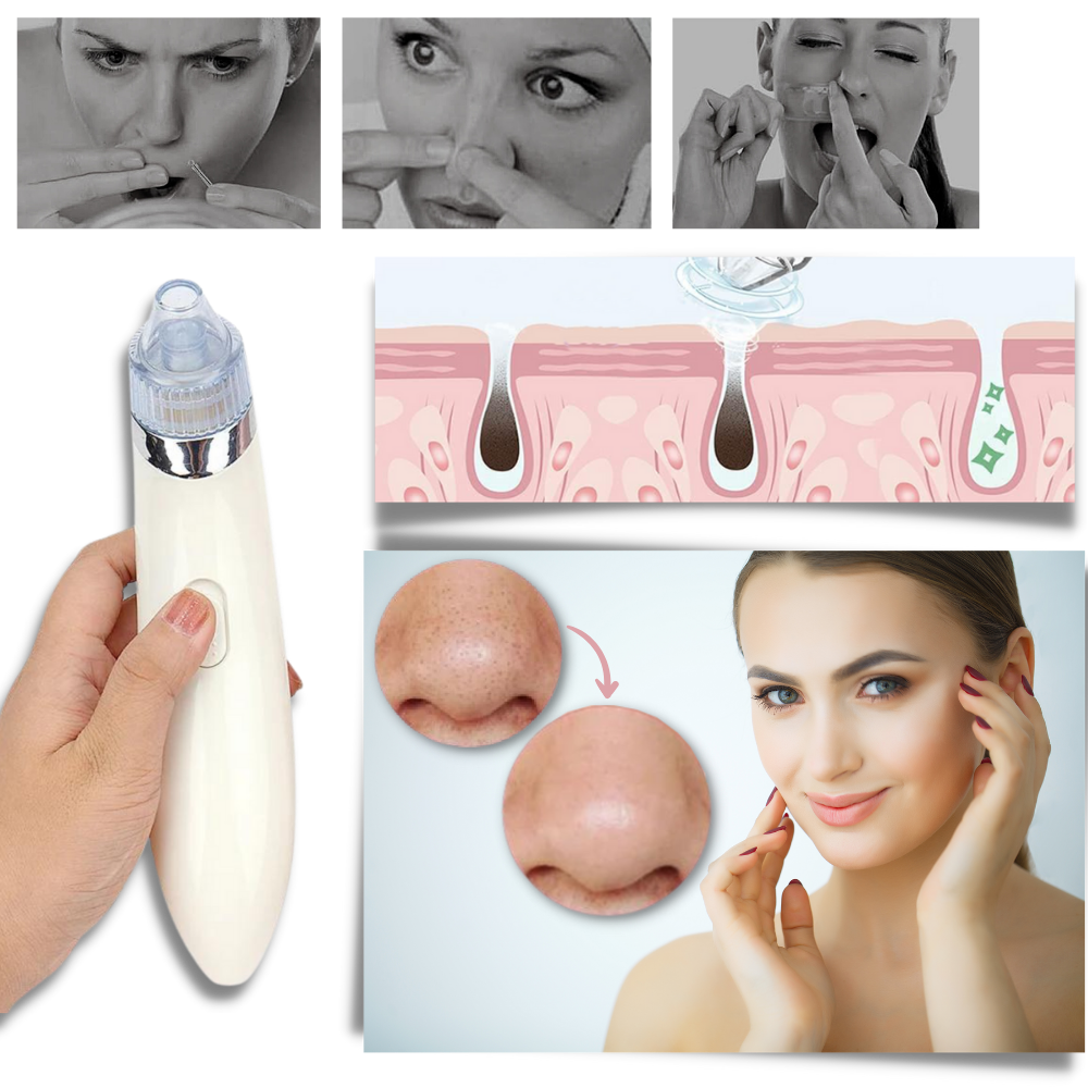 Aspirateur de points noirs du visage